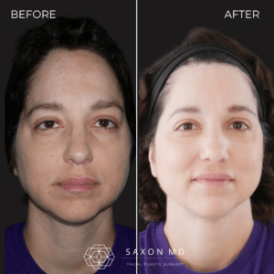 Forehead Reduction Surgery Before And After