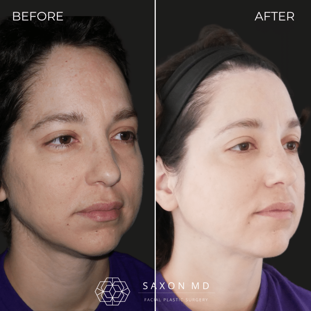 forehead reduction surgery before and after photo of a patient at Saxon MD in Austin, TX; hairline lowering before and after