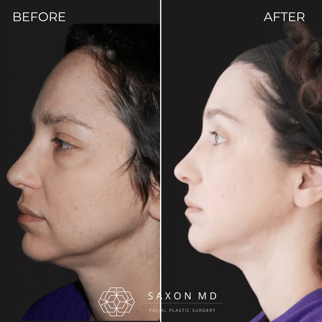 Forehead Reduction Surgery Before And After