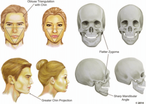 comparing male vs female face structure for facial feminization surgery