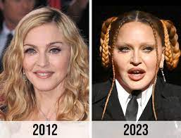 madonna liquid facelift before and after describing pillow face