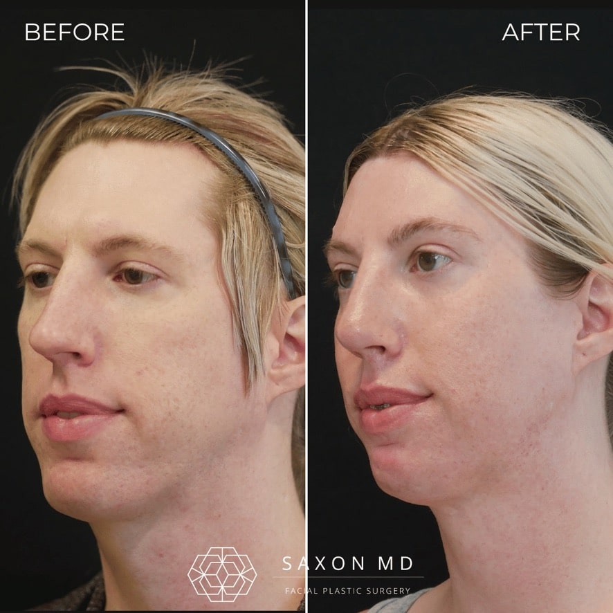 facial feminization surgery before and after photo from a patient at Saxon MD in Austin and Dallas, TX; ffs before and after