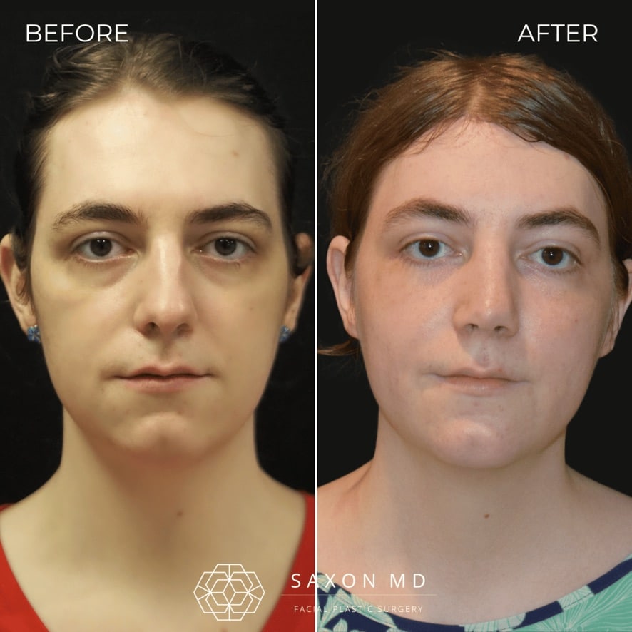 facial feminization surgery before and after photo from a patient at Saxon MD in Austin and Dallas, TX; ffs before and after