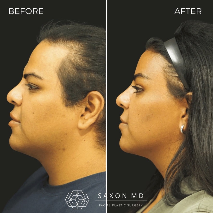 facial feminization surgery before and after photo from a patient at Saxon MD in Austin and Dallas, TX; ffs before and after