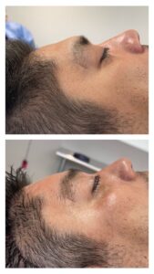 brow bone reduction before and after depicting brow bone reduction in men