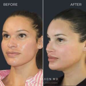 forehead reduction vs hair transplant; brow bone reduction before and after; hairline lowering before and after