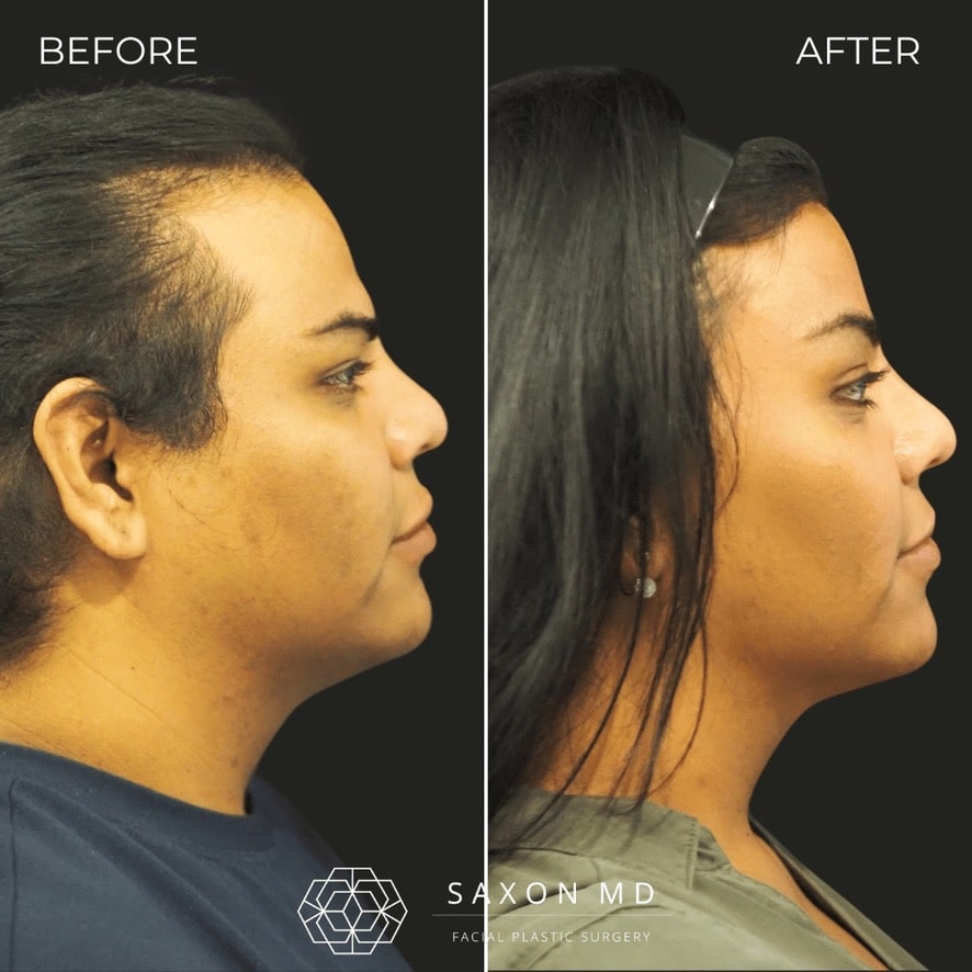 facial feminization surgery before and after photo from a patient at Saxon MD in Austin and Dallas, TX; ffs before and after