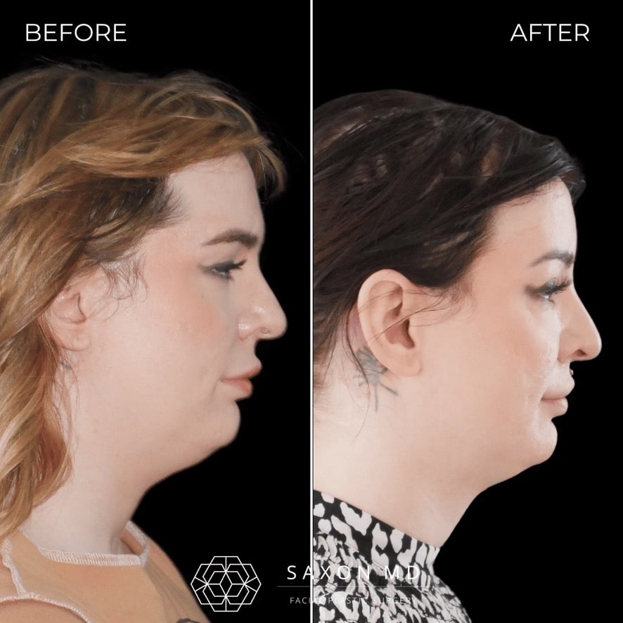 facial feminization surgery before and after photo from a patient at Saxon MD in Austin and Dallas, TX; ffs before and after