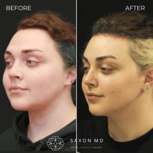 brow bone reduction before and after, facial feminization surgery before and after 