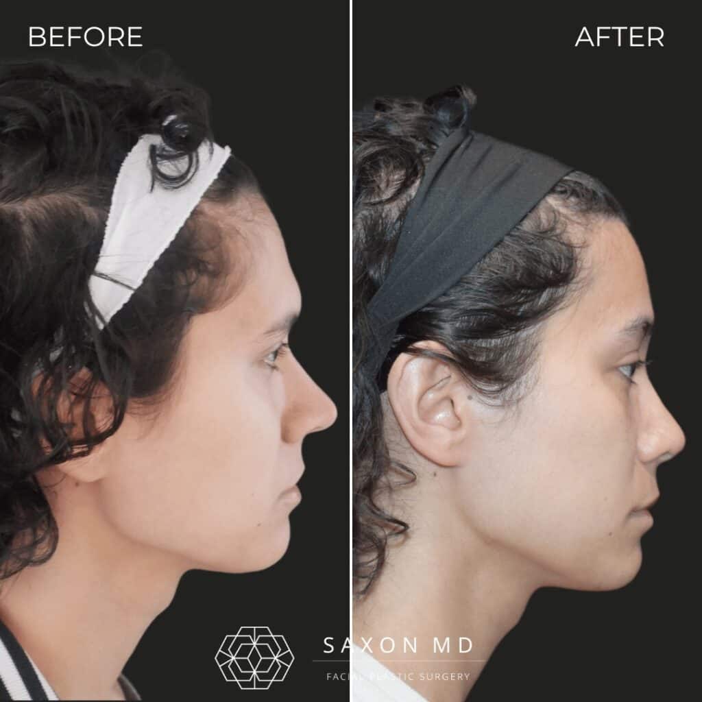 facial feminization surgery before and after photo from a patient at Saxon MD in Austin and Dallas, TX; ffs before and after; rhinoplasty before and after