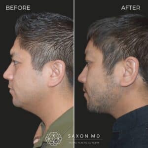 deep plane facelift before and after at saxon md in Austin and Dallas, TX; facelift austin; facelift dallas