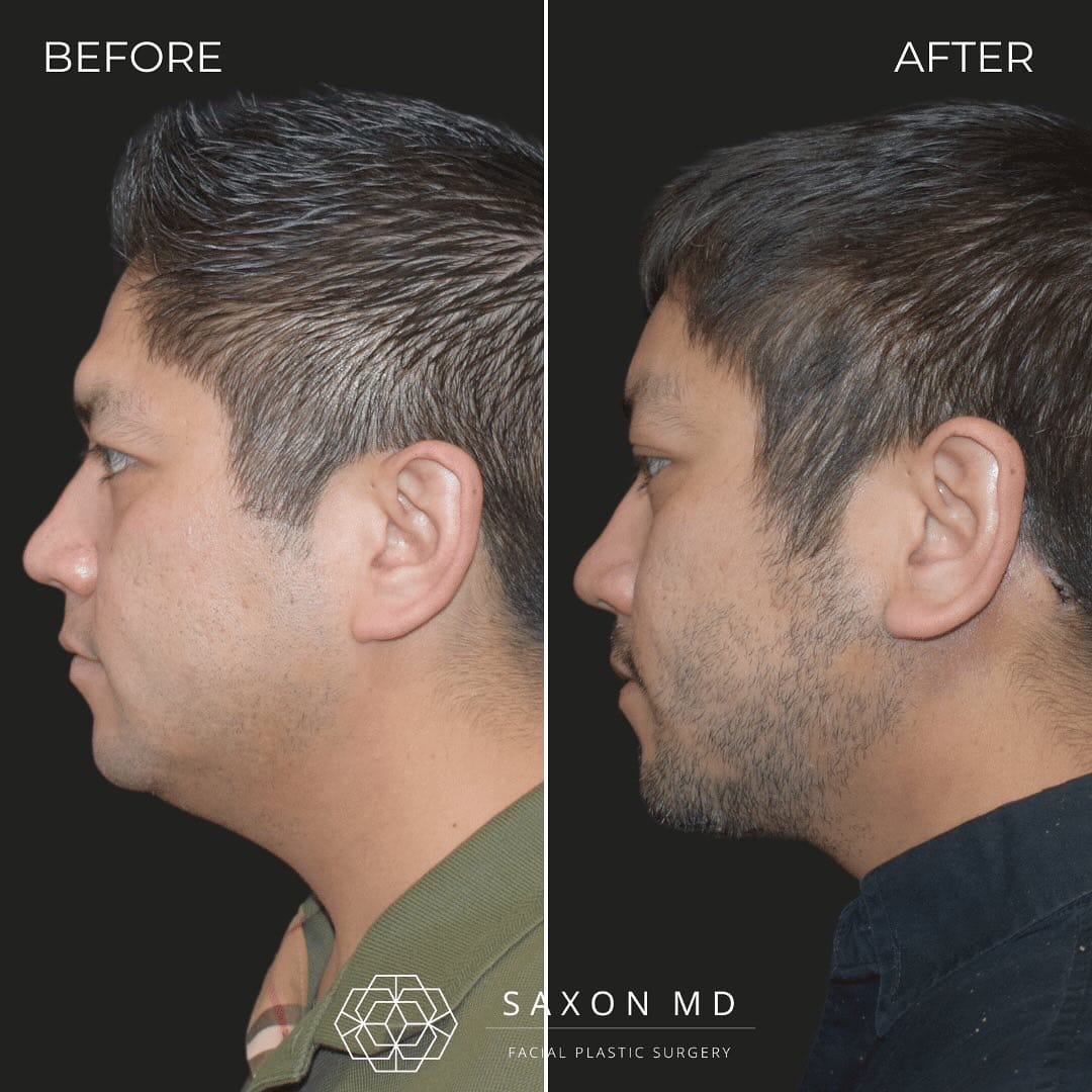top-surgical-procedures-that-can-redefine-your-side-profile