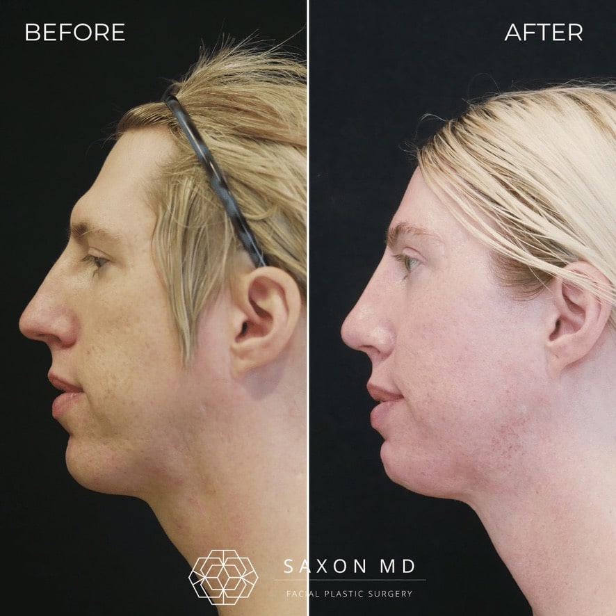 facial feminization surgery before and after photo from a patient at Saxon MD in Austin and Dallas, TX; ffs before and after