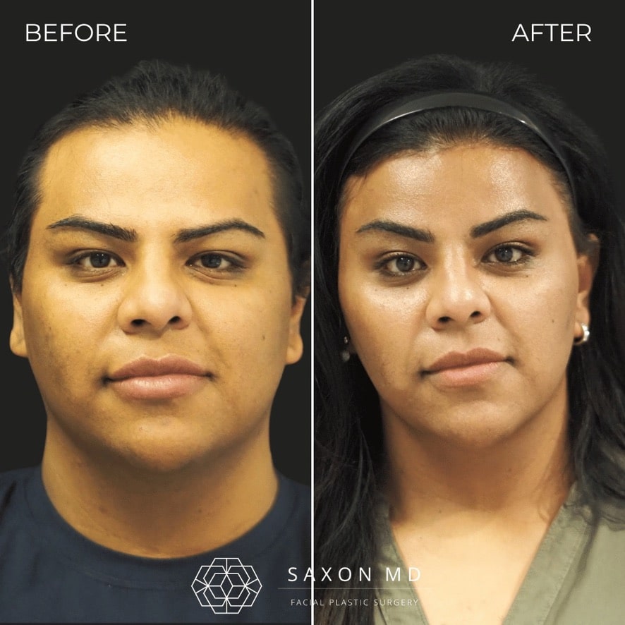 facial feminization surgery before and after photo from a patient at Saxon MD in Austin and Dallas, TX; ffs before and after