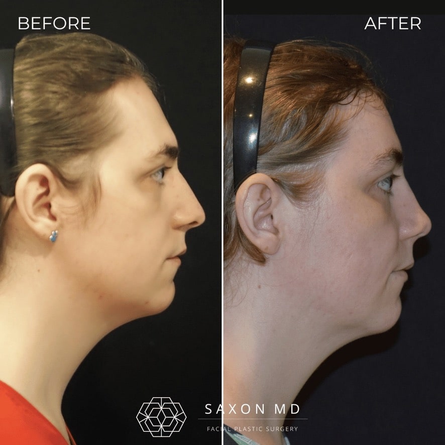 facial feminization surgery before and after photo from a patient at Saxon MD in Austin and Dallas, TX; ffs before and after