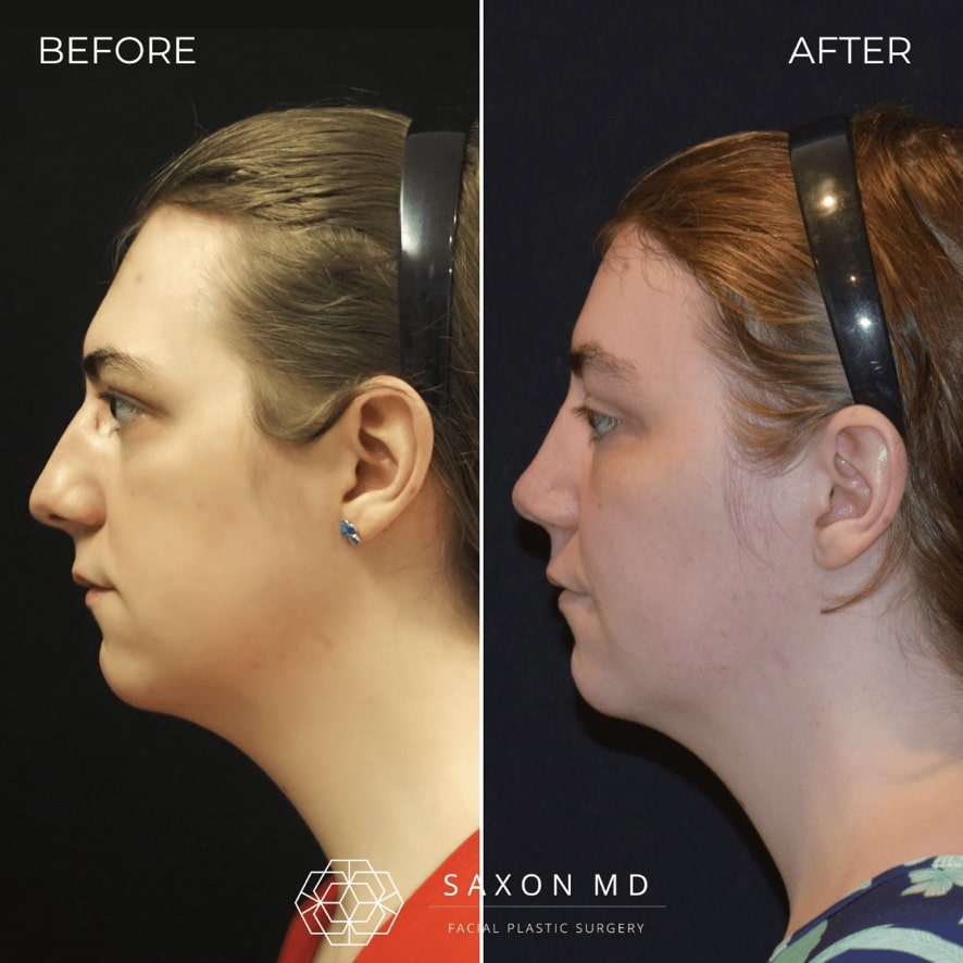 facial feminization surgery before and after photo from a patient at Saxon MD in Austin and Dallas, TX; ffs before and after