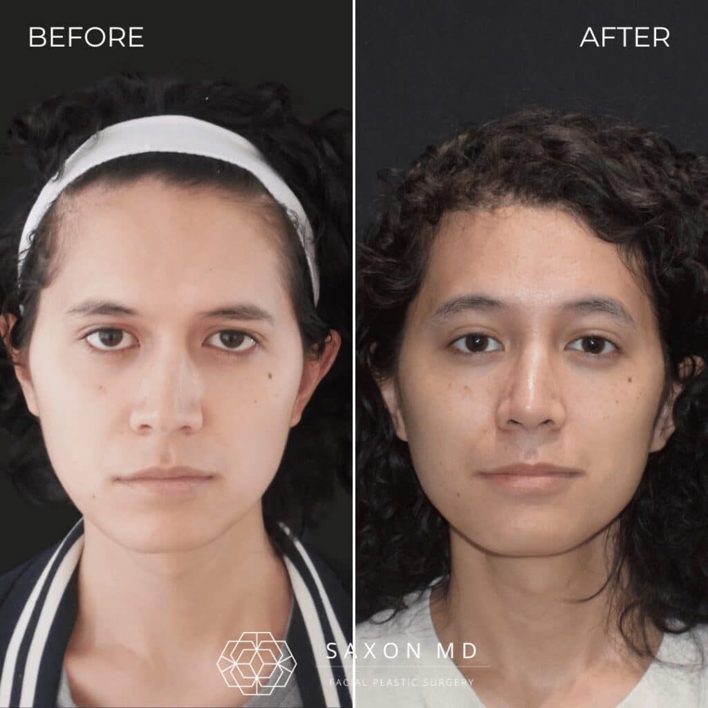 rhinoplasty before and after photo from Saxon MD in Austin and Dallas, TX; rhinoplasty Austin