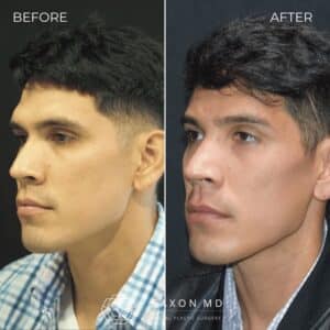 brow bone reduction in men, Saxon MD in Austin and Dallas, TX