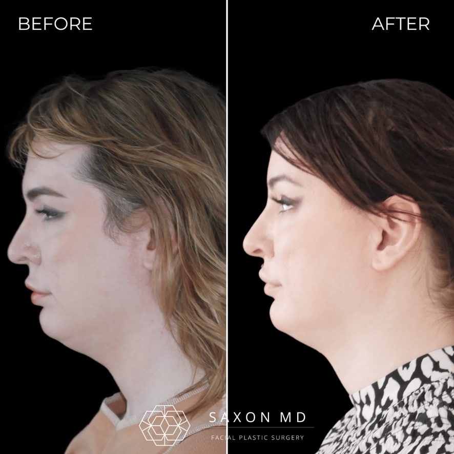 facial feminization surgery before and after photo from a patient at Saxon MD in Austin and Dallas, TX; ffs before and after