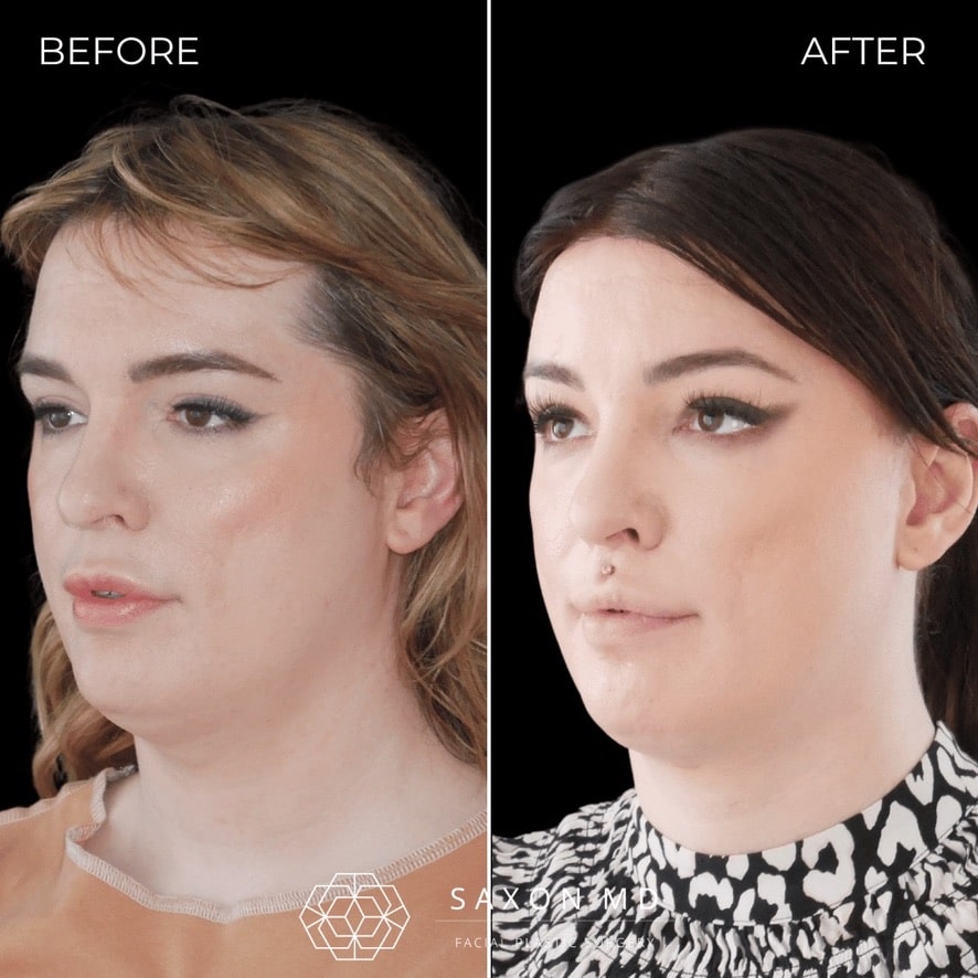 facial feminization surgery before and after photo from a patient at Saxon MD in Austin and Dallas, TX; ffs before and after