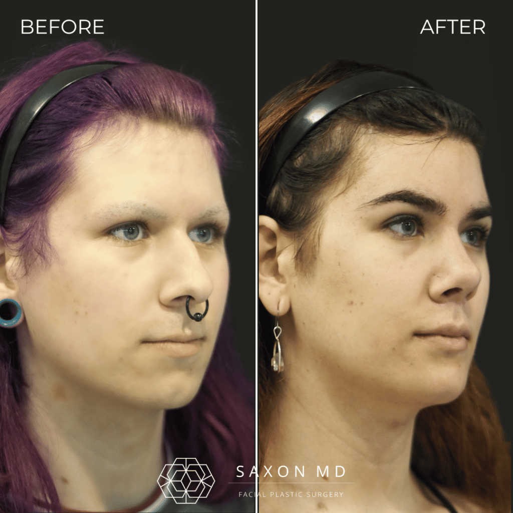 facial feminization surgery before and after photo from a patient at Saxon MD in Austin and Dallas, TX; ffs before and after