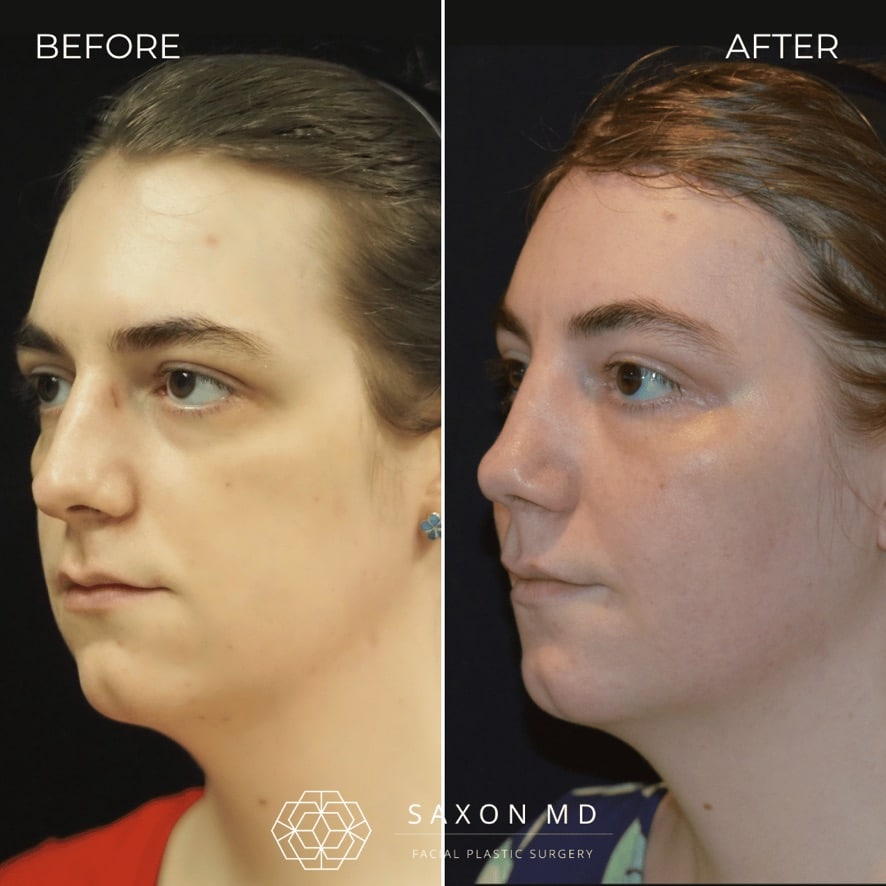 facial feminization surgery before and after photo from a patient at Saxon MD in Austin and Dallas, TX; ffs before and after