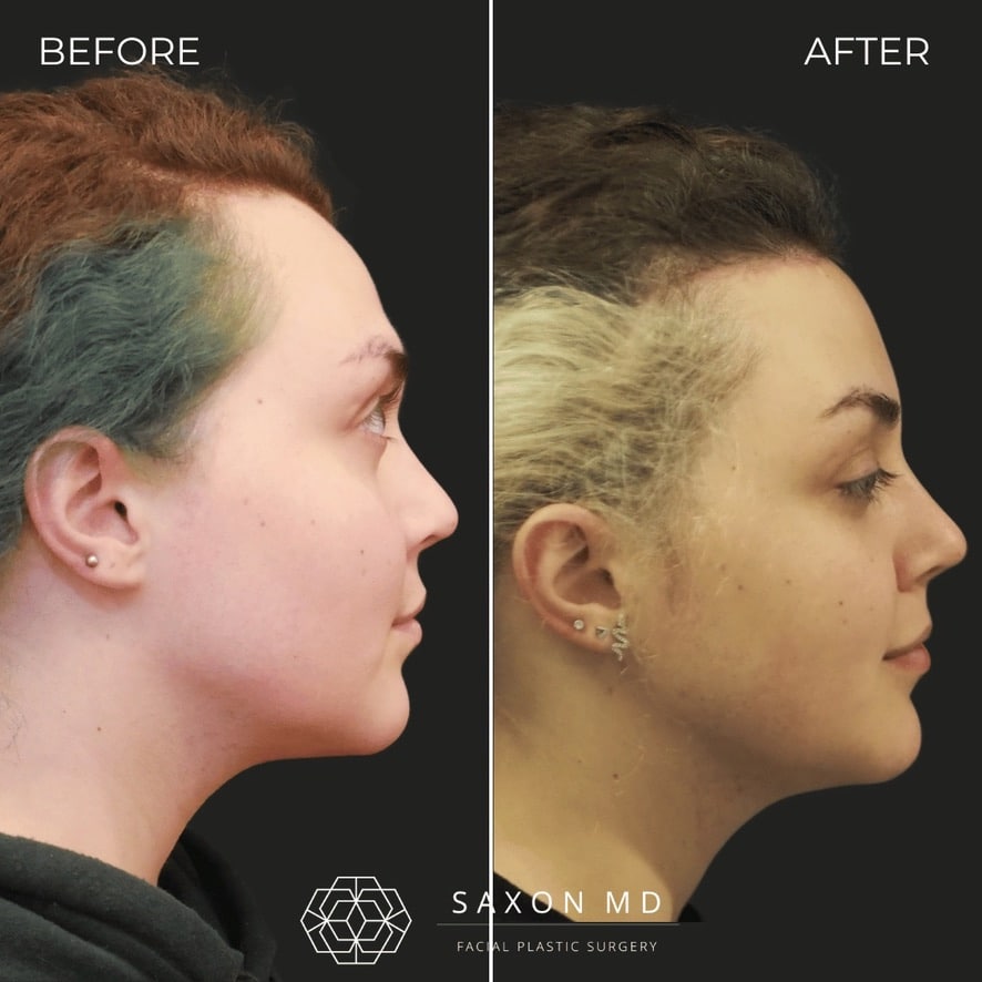 facial feminization surgery before and after photo from a patient at Saxon MD in Austin and Dallas, TX; ffs before and after