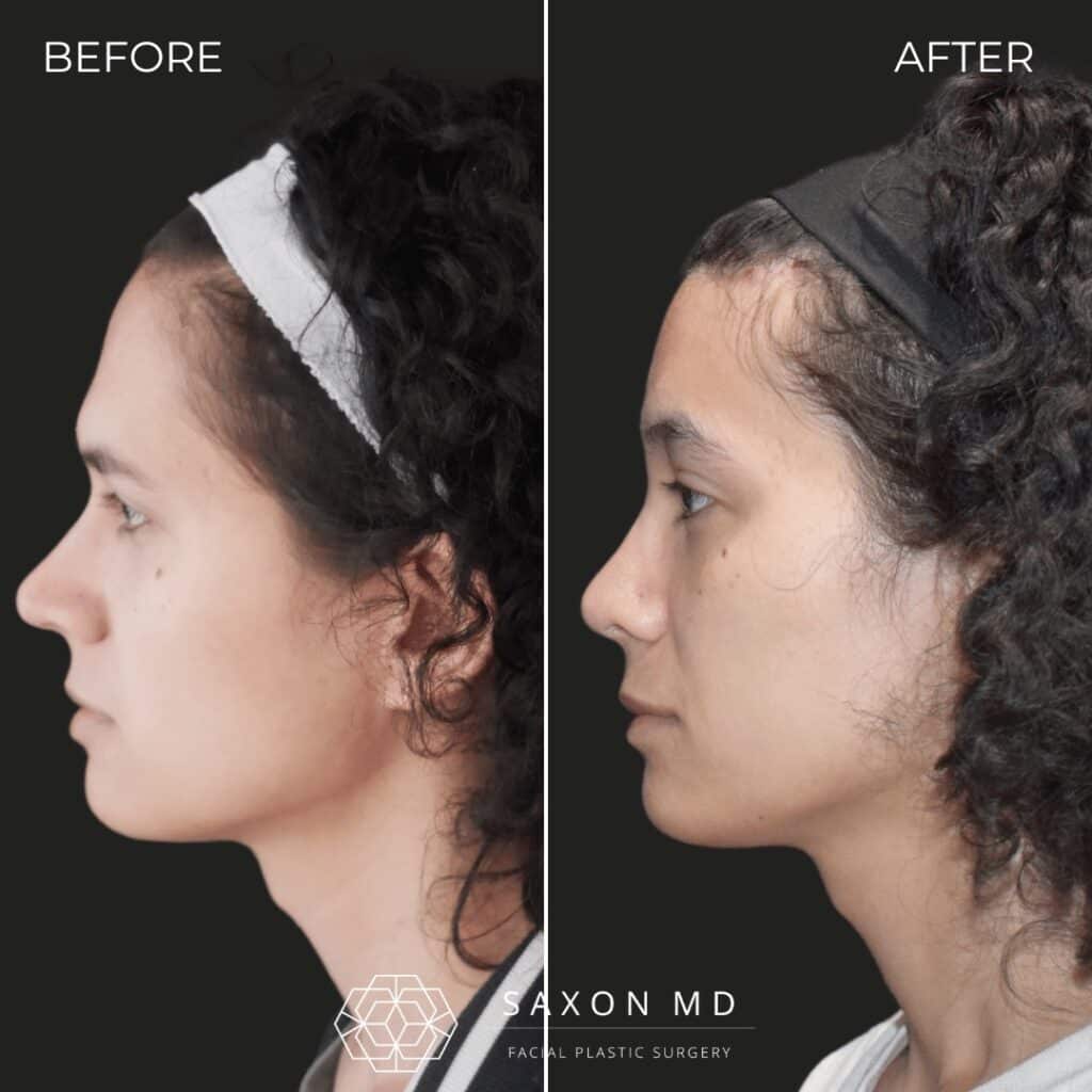 facial feminization surgery before and after photo from a patient at Saxon MD in Austin and Dallas, TX; ffs before and after; rhinoplasty before and after