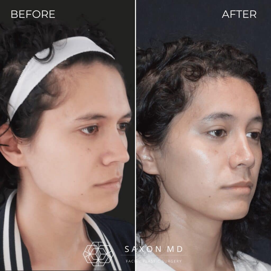 rhinoplasty before and after photo from Saxon MD in Austin and Dallas, TX; rhinoplasty Austin