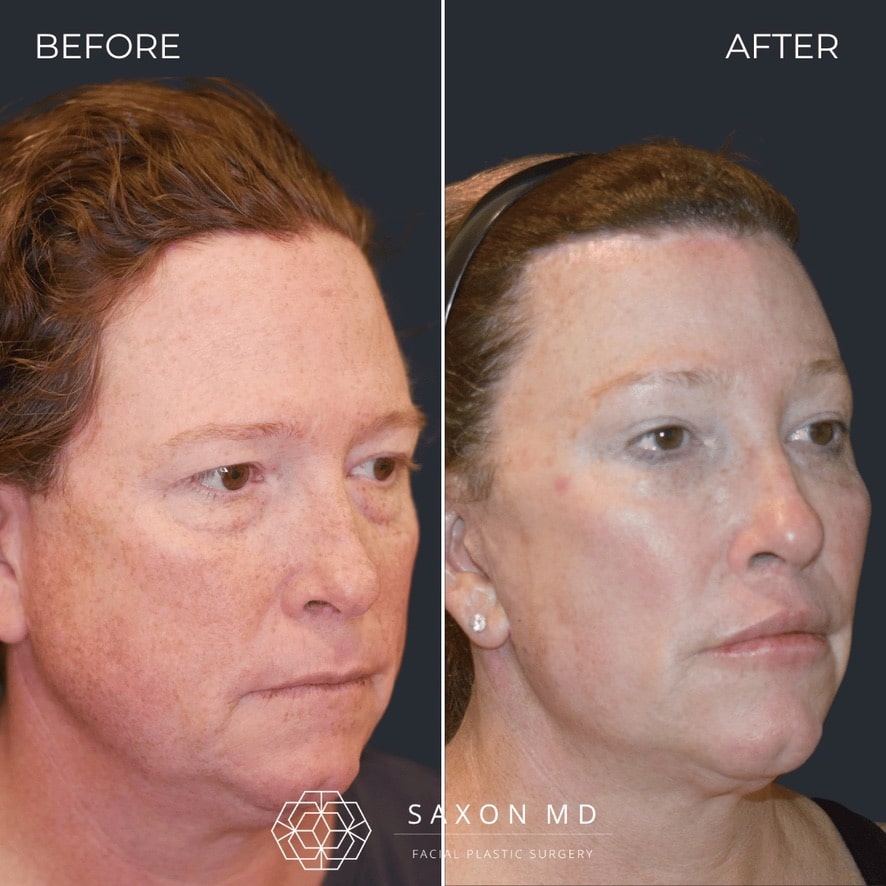 facial feminization surgery before and after photo from a patient at Saxon MD in Austin and Dallas, TX; ffs before and after