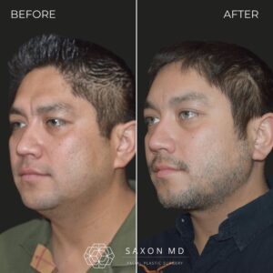structural neck lift austin, TX; how to get a better jawline
