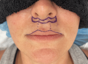 photo of a bullhorn lip lift to explain different types of lip lifts