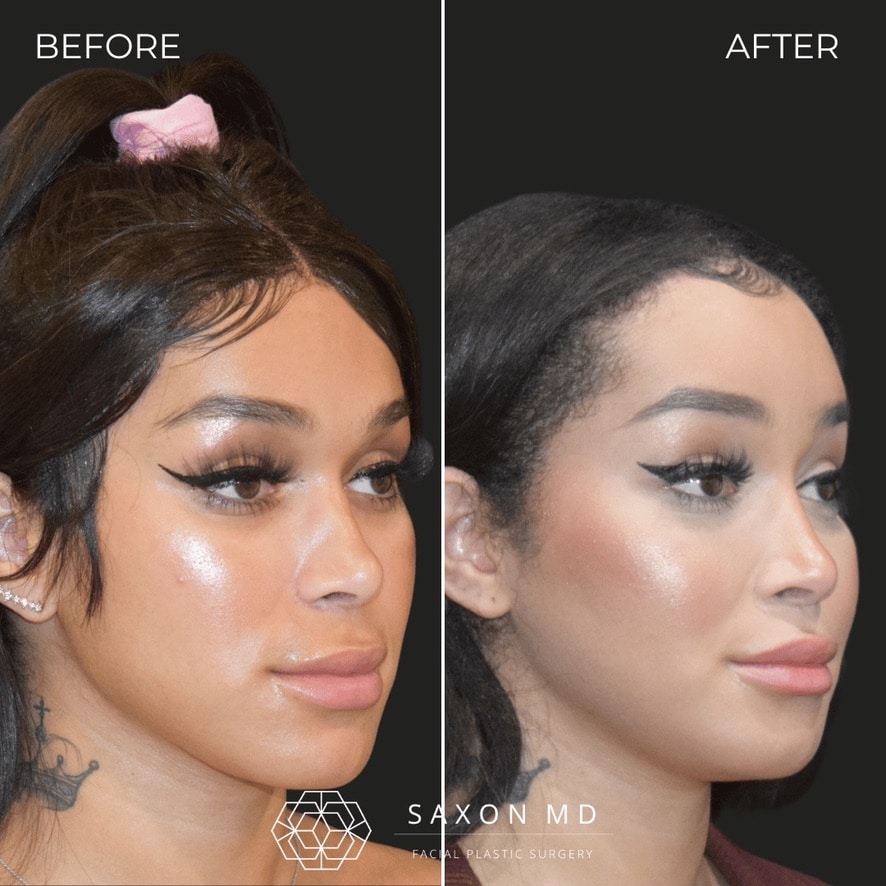 facial feminization surgery before and after photo from a patient at Saxon MD in Austin and Dallas, TX; ffs before and after