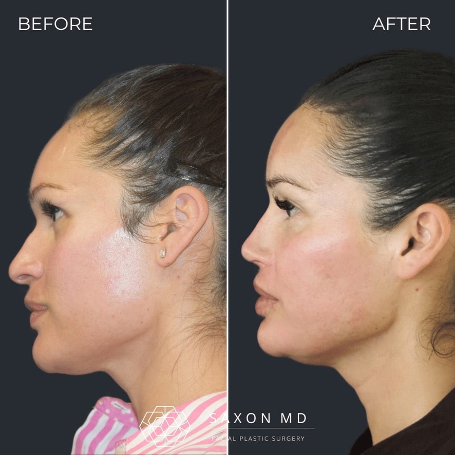 facial feminization surgery before and after photo from a patient at Saxon MD in Austin and Dallas, TX; ffs before and after