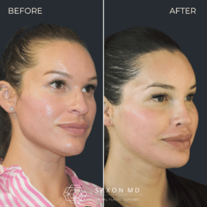 facial feminization surgery before and after photo from a patient at Saxon MD in Austin and Dallas, TX; ffs before and after; m shaped hairline