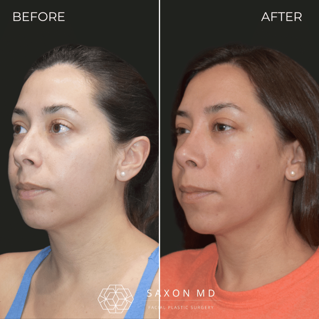 rhinoplasty before and after photo from Saxon MD in Austin and Dallas, TX; rhinoplasty Austin