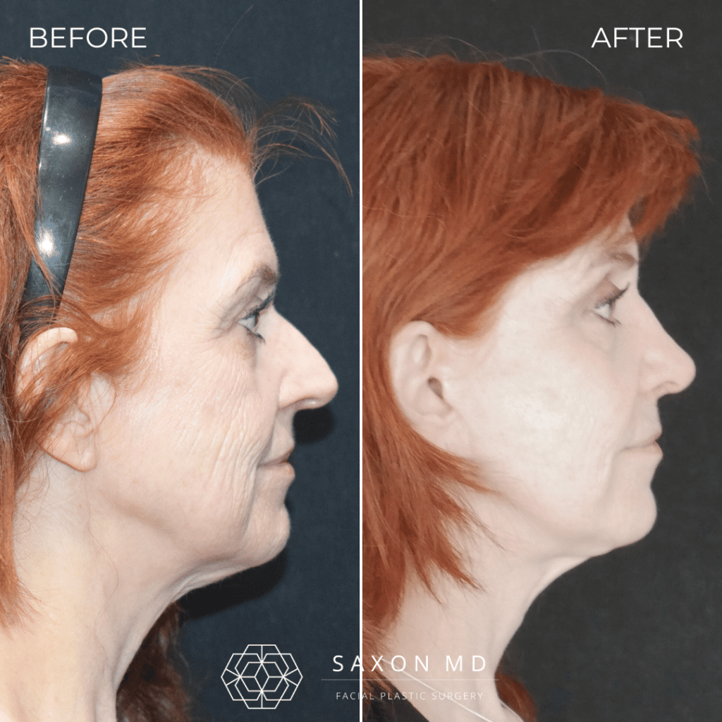 rhinoplasty before and after photo from Saxon MD in Austin and Dallas, TX; rhinoplasty Austin; facelift before and after; brow lift before and after