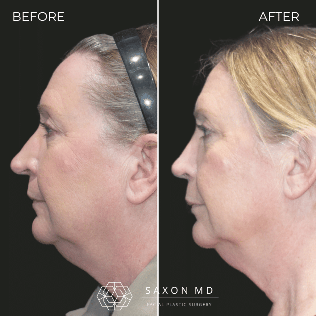 rhinoplasty before and after photo from Saxon MD in Austin and Dallas, TX; rhinoplasty Austin