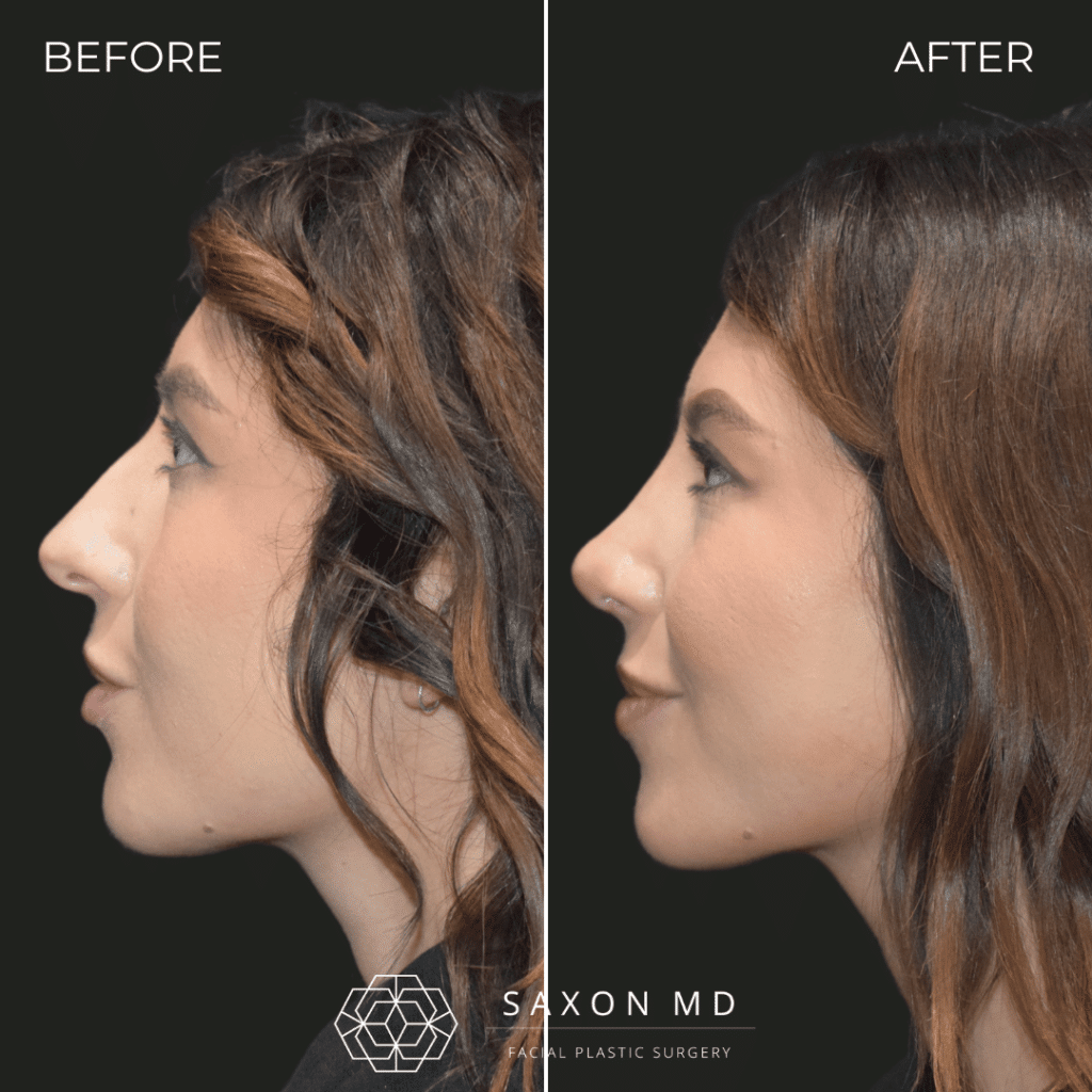 rhinoplasty before and after photo from Saxon MD in Austin and Dallas, TX; rhinoplasty Austin