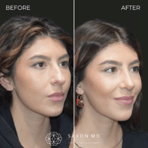 rhinoplasty before and after photo from Saxon MD in Austin and Dallas, TX; rhinoplasty Austin; rhinoplasty cost
