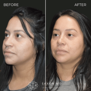 rhinoplasty before and after photo from Saxon MD in Austin and Dallas, TX; rhinoplasty Austin; nose job recovery time