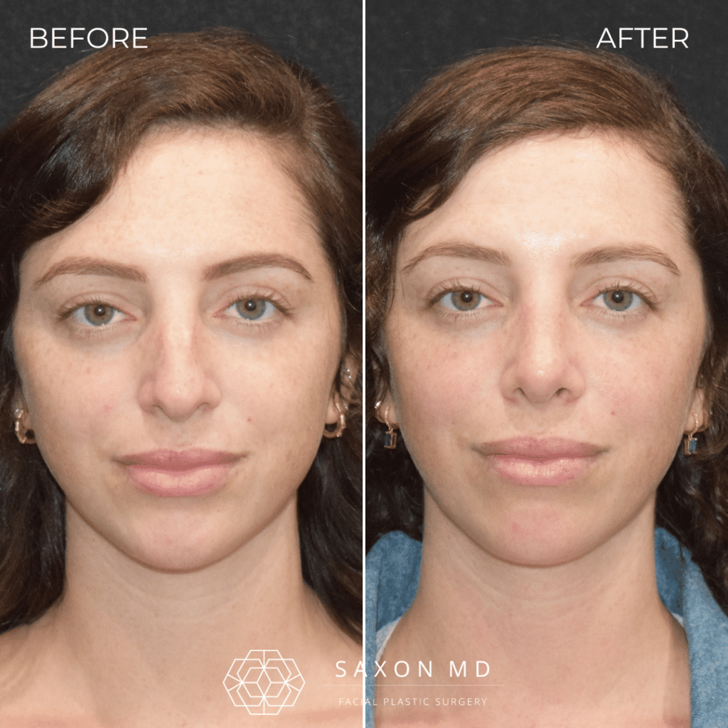 rhinoplasty before and after photo from Saxon MD in Austin and Dallas, TX; rhinoplasty Austin