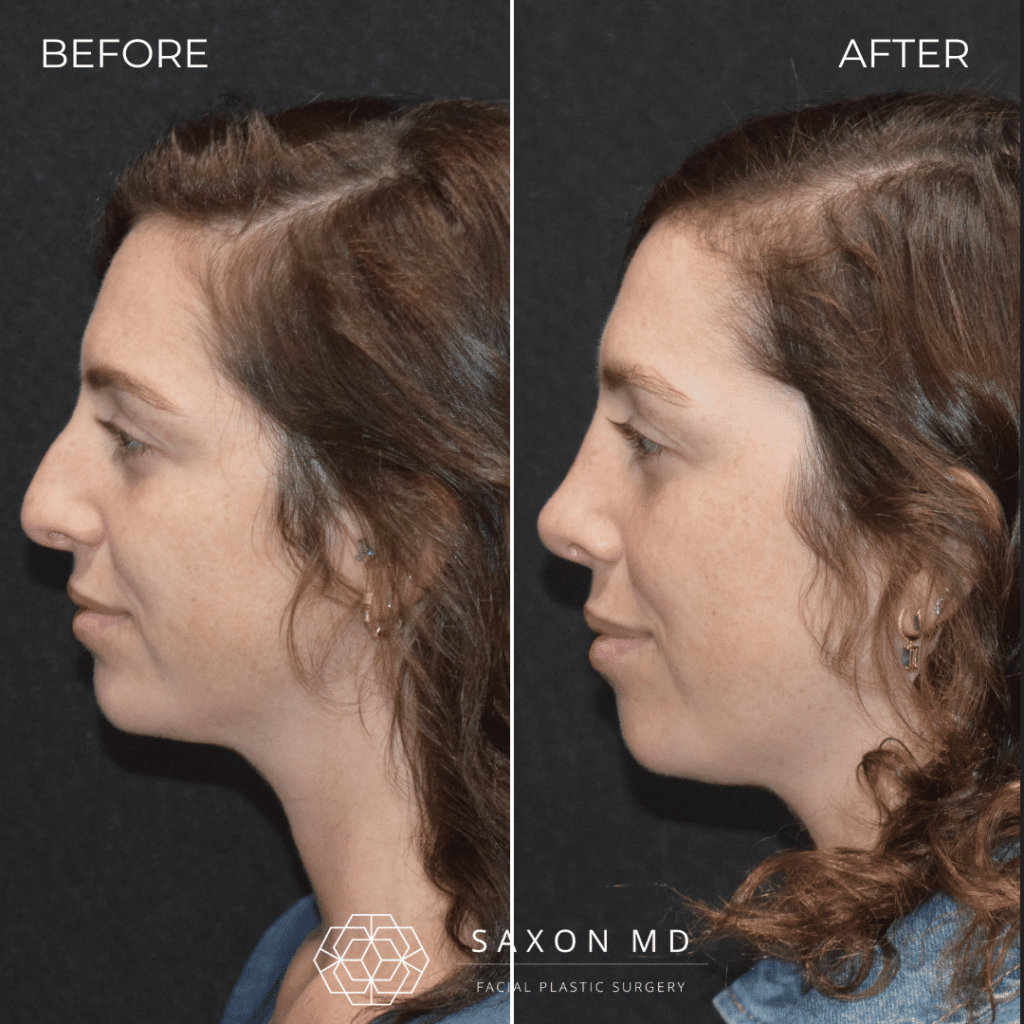 rhinoplasty before and after photo from Saxon MD in Austin and Dallas, TX; rhinoplasty Austin