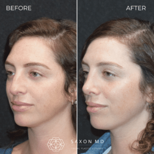 rhinoplasty before and after photo from Saxon MD in Austin and Dallas, TX; rhinoplasty Austin; rhinoplasty cost