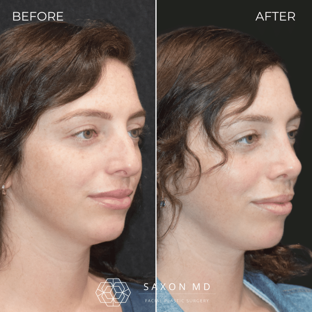 rhinoplasty before and after photo from Saxon MD in Austin and Dallas, TX; rhinoplasty Austin