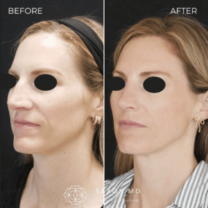 rhinoplasty before and after photos from Saxon MD in Austin and Dallas, TX; rhinoplasty austin; nose job recovery time