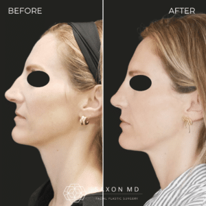 rhinoplasty before and after photos from Saxon MD in Austin and Dallas, TX; rhinoplasty austin; rhinoplasty cost