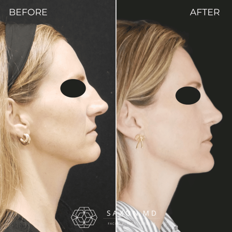 Before and after rhinoplasty, side profile, by Austin facial plastic surgeon Dr. Sarah Saxon