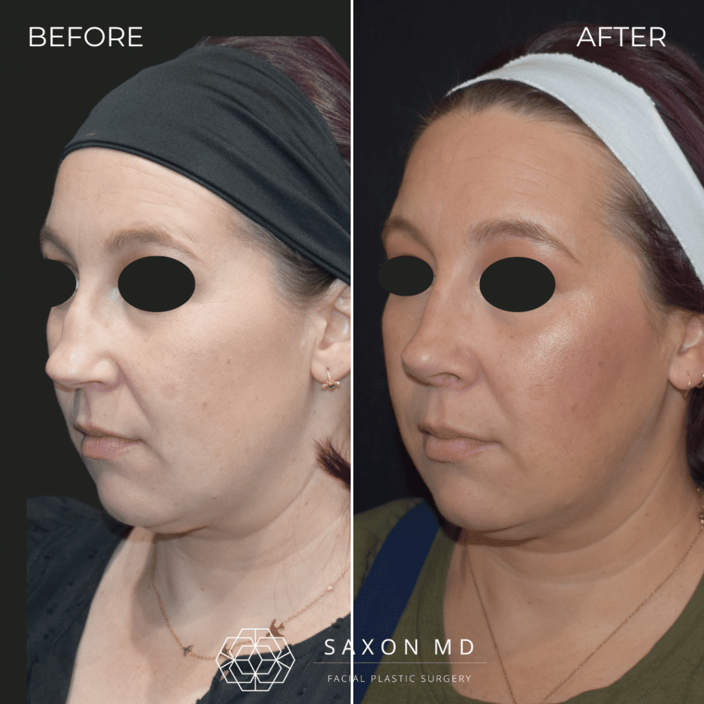 rhinoplasty before and after photos from Saxon MD in Austin and Dallas, TX; rhinoplasty austin