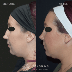 rhinoplasty before and after photos from Saxon MD in Austin and Dallas, TX; rhinoplasty austin; rhinoplasty cost
